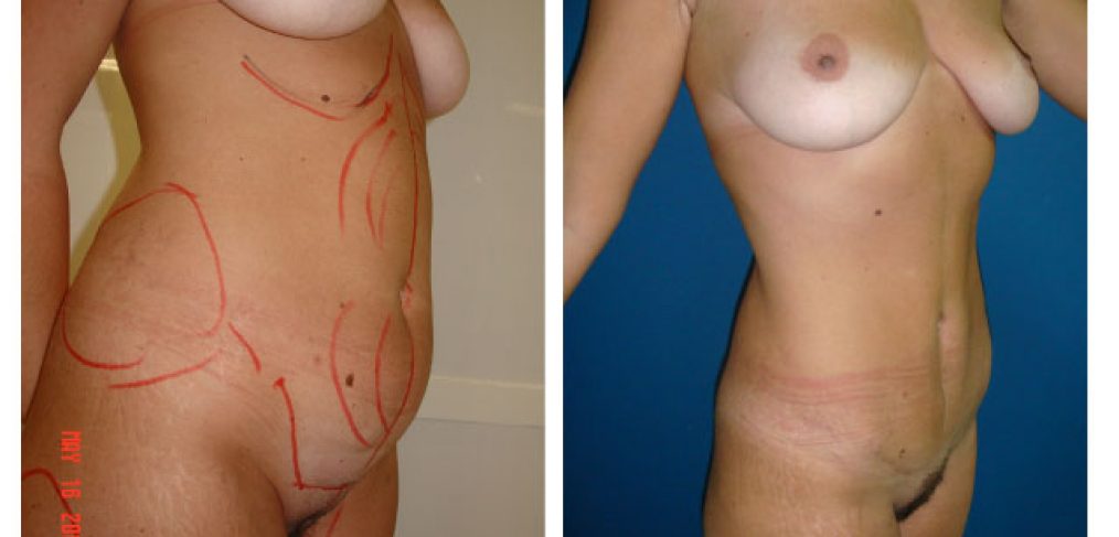 Breast lift + abdominoplasty Before and After
