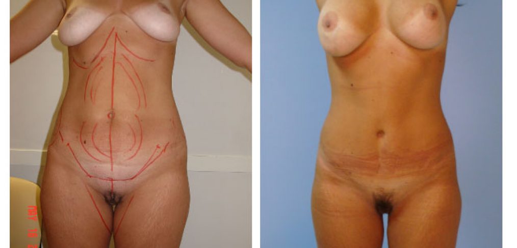 Breast lift + abdominoplasty Before and After