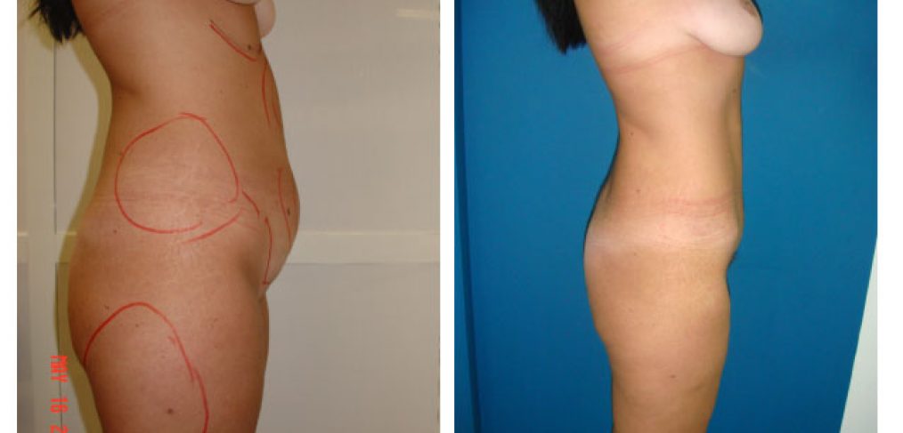 Breast lift + abdominoplasty Before and After