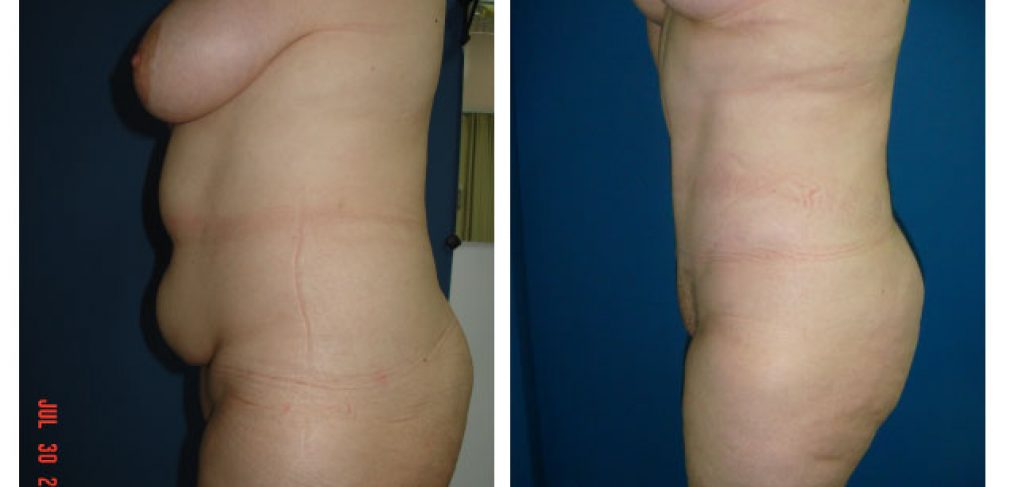 Breast lift + abdominoplasty Before and After