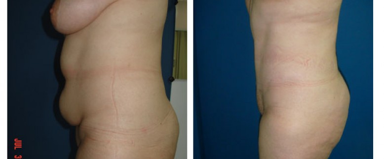 Breast lift + abdominoplasty Before and After