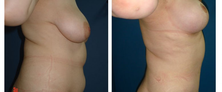 Breast lift + abdominoplasty