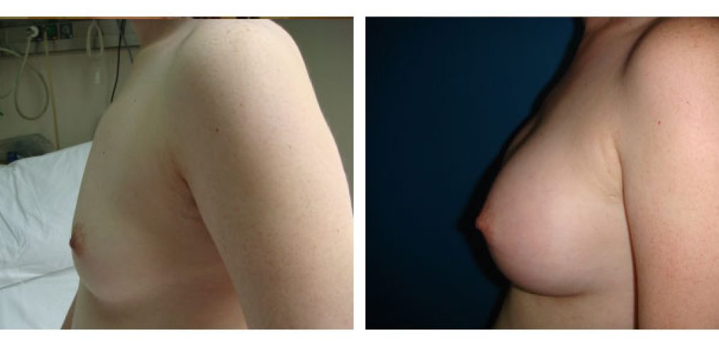 breast augmentation Before and After