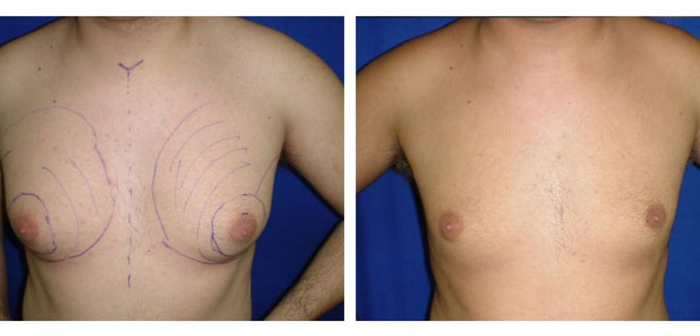 Gynecomastia liposculpture Before and After