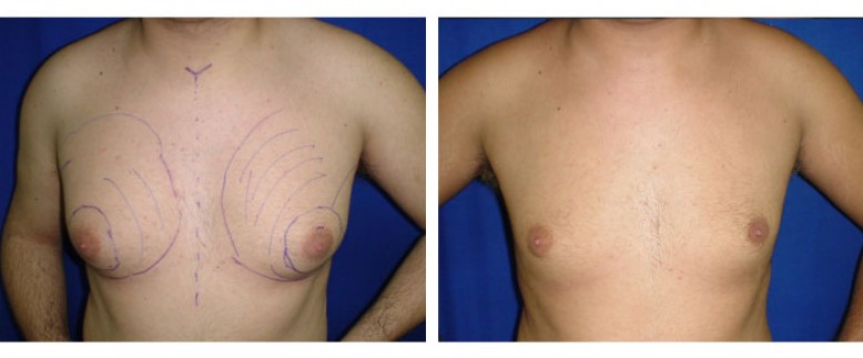 Gynecomastia liposculpture Before and After