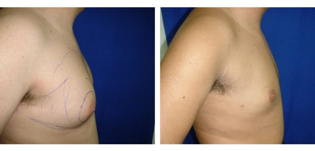 Gynecomastia liposculpture Before and After