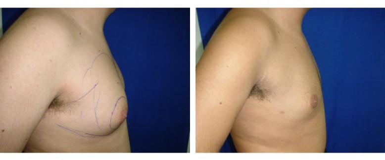 Gynecomastia liposculpture Before and After