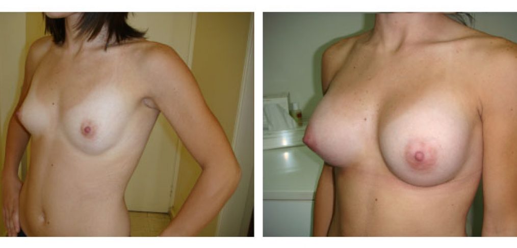 breast augmentation Before and After