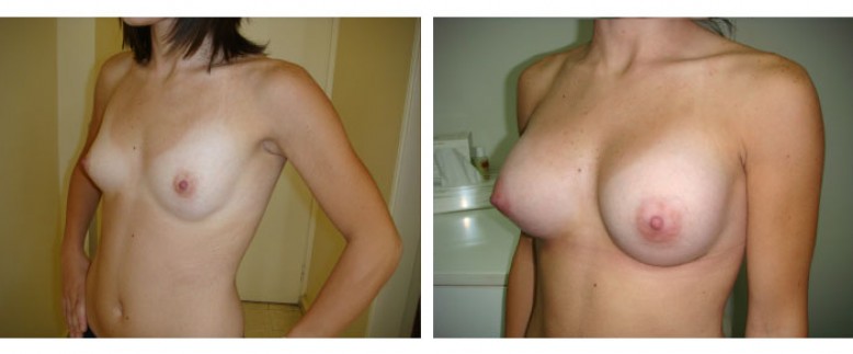 breast augmentation Before and After