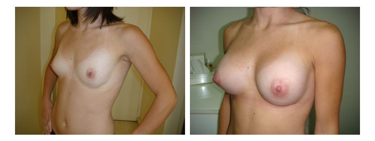 11_breast8