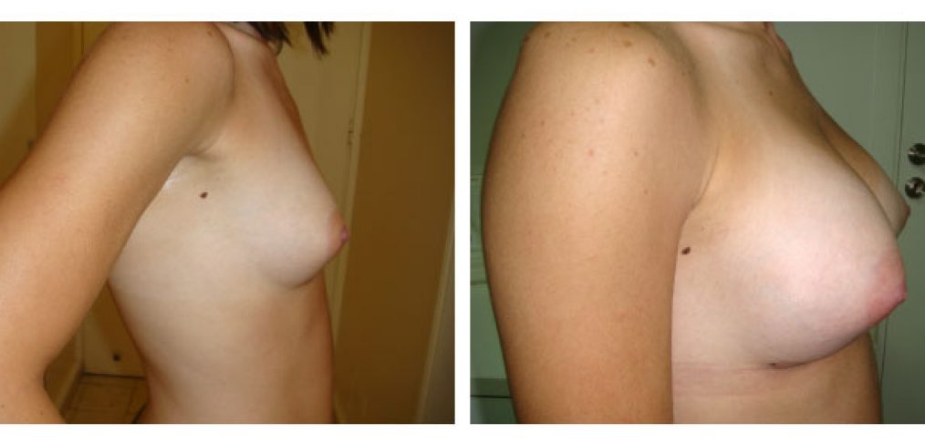 breast augmentation Before and After