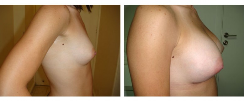 breast augmentation Before and After