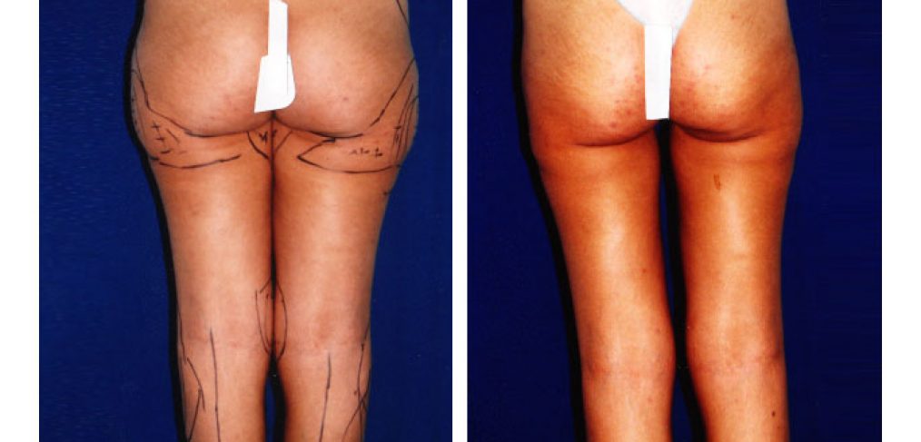 Liposculpture Before and After