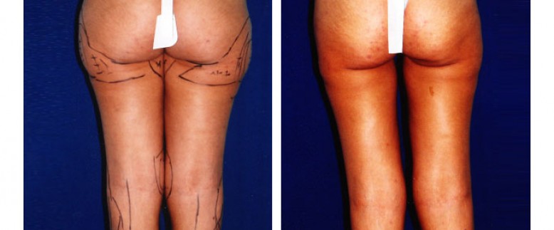 Liposculpture Before and After