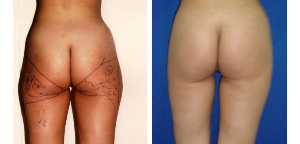 Liposculpture Before and After