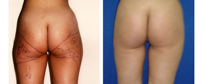 Liposculpture Before and After