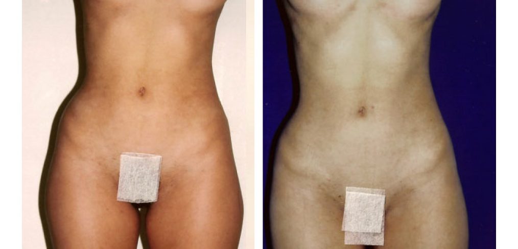 Liposculpture Before and After