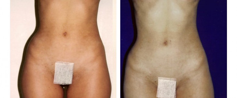 Liposculpture Before and After