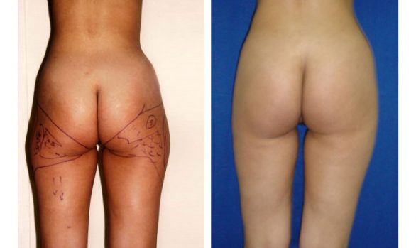 Liposuction Before and After