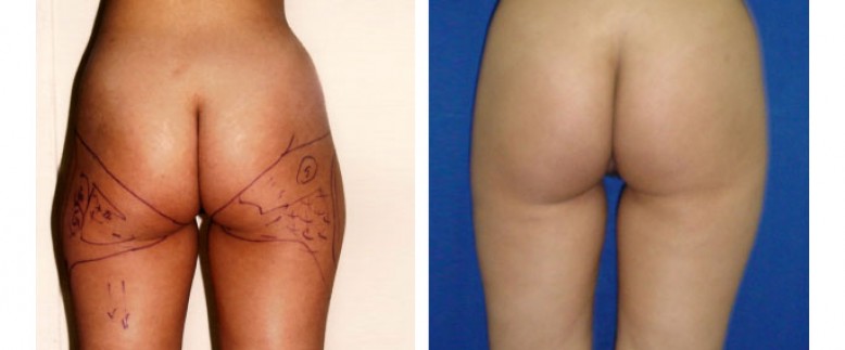 Liposuction Before and After