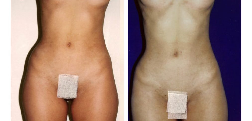 Liposuction Before and After