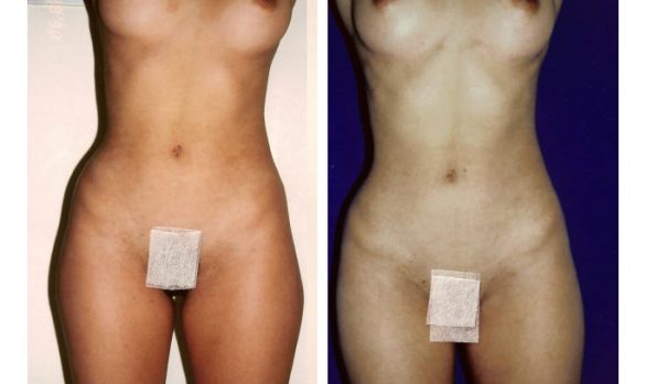 Liposuction Before and After