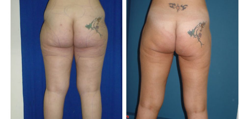 Liposuction Before and After