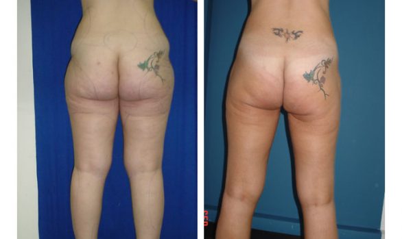 Liposuction Before and After