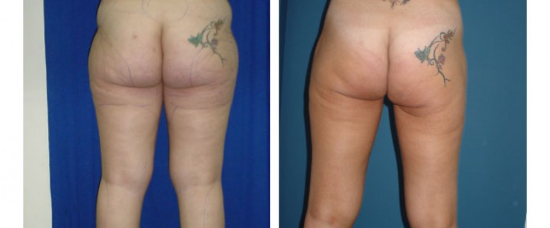 Liposuction Before and After