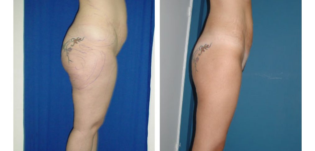 Liposuction Before and After