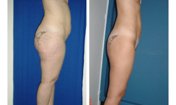 Liposuction Before and After