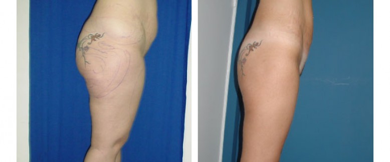 Liposuction Before and After