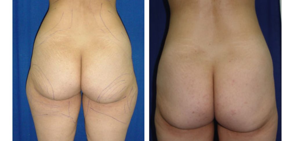Liposuction Before and After