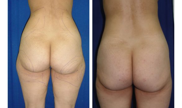 Liposuction Before and After