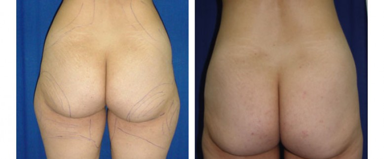 Liposuction Before and After