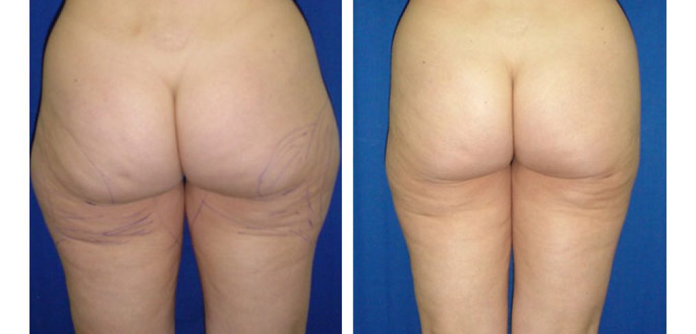 Liposuction Before and After