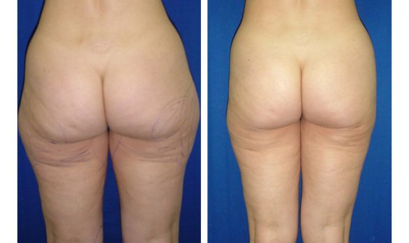 Liposuction Before and After