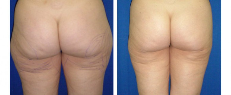 Liposuction Before and After