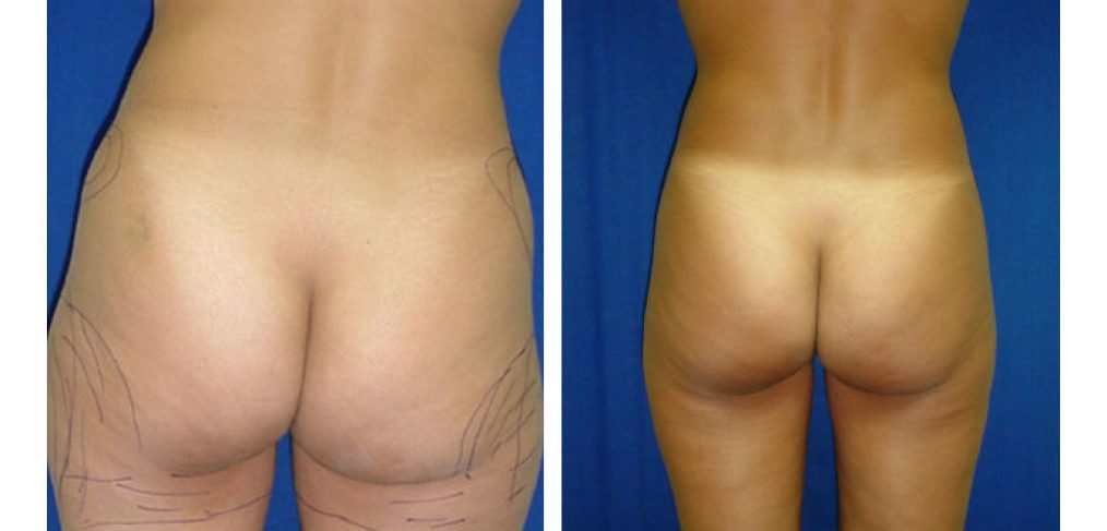 Liposuction Before and After