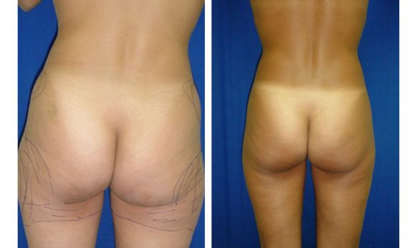 Liposuction Before and After