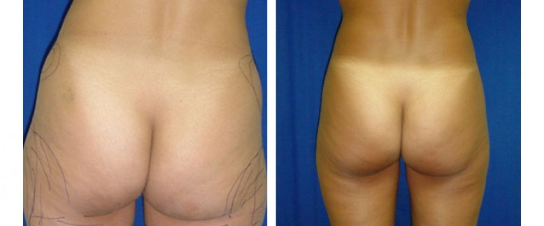 Liposuction Before and After