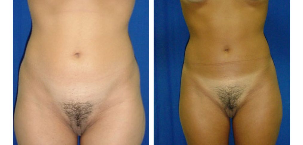 Liposuction Before and After