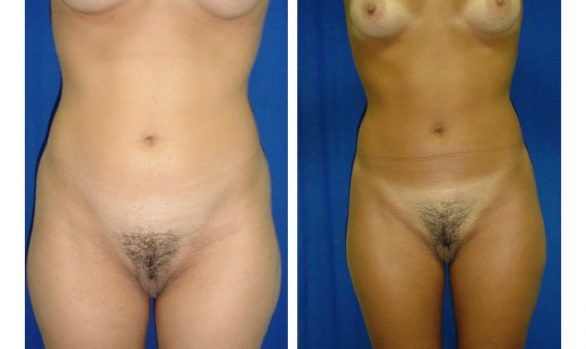 Liposuction Before and After