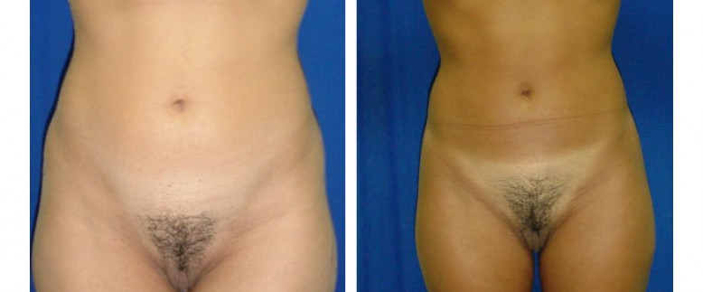 Liposuction Before and After