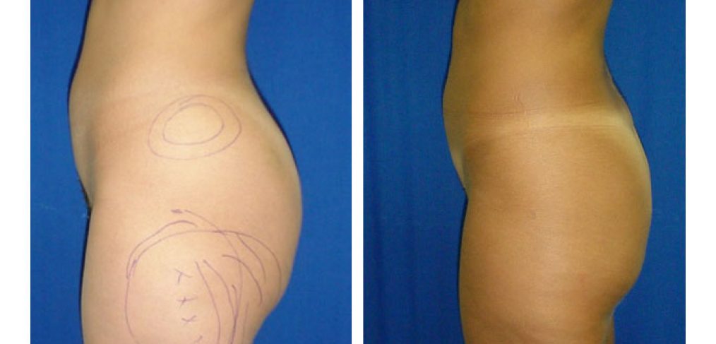 Liposuction Before and After