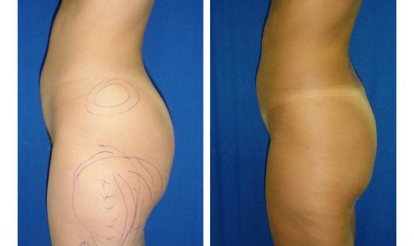 Liposuction Before and After