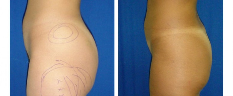 Liposuction Before and After