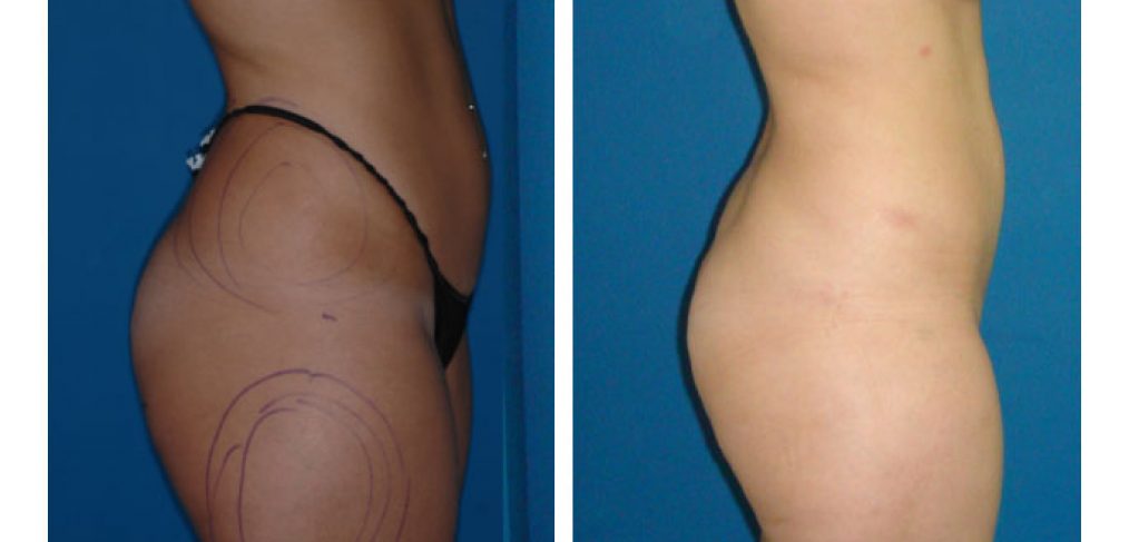 Liposuction Before and After