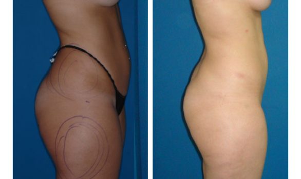 Liposuction Before and After