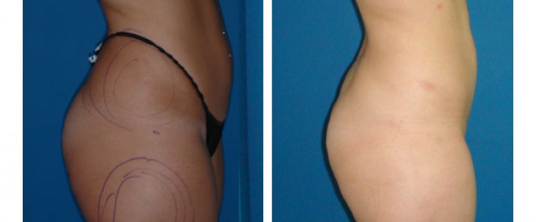 Liposuction Before and After